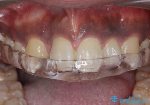 歯ぎしりが気になる。の症例 治療後