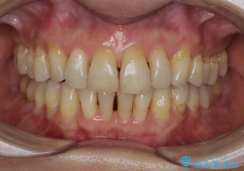 ナイトガードで歯の予防の症例 治療前
