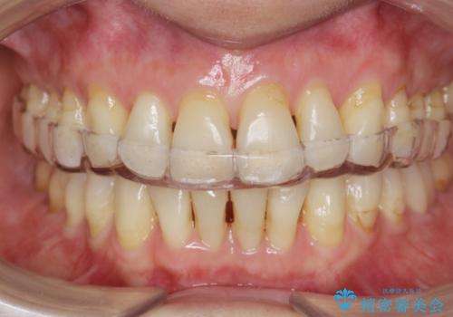 ナイトガードで歯の予防の治療後