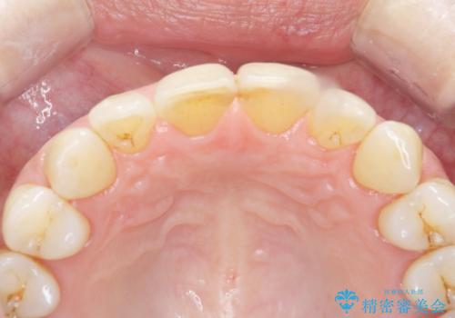 ナイトガードで歯の予防の治療前