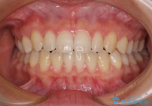 隙間だらけの歯列 インビザラインで改善の治療後