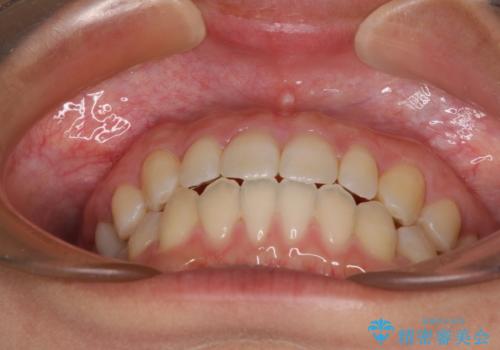 隙間だらけの歯列 インビザラインで改善の治療後