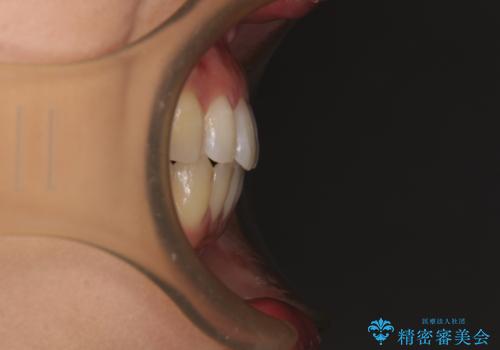 隙間だらけの歯列 インビザラインで改善の治療後