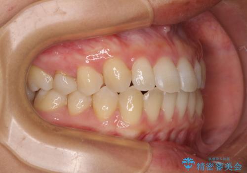 隙間だらけの歯列 インビザラインで改善の治療後