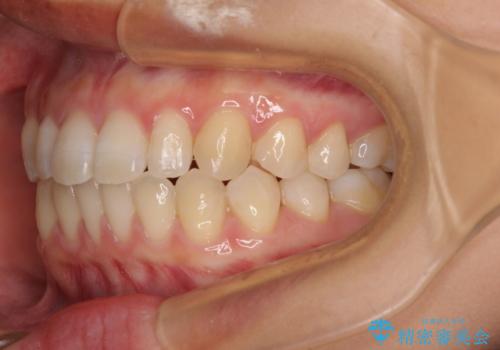 隙間だらけの歯列 インビザラインで改善の治療後