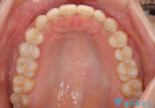 隙間だらけの歯列 インビザラインで改善の治療後