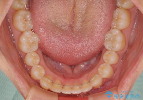 隙間だらけの歯列 インビザラインで改善の治療後