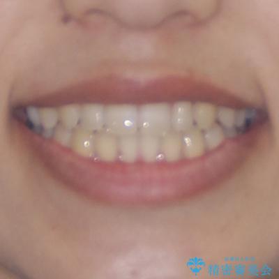 隙間だらけの歯列 インビザラインで改善の治療後(顔貌)