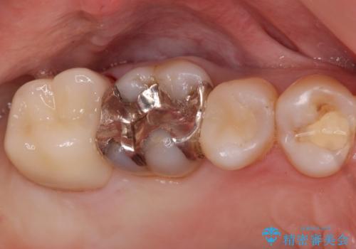 奥歯がしみて痛いの治療後
