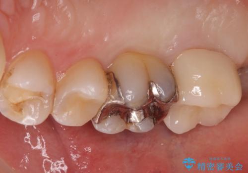 奥歯がしみて痛いの治療後