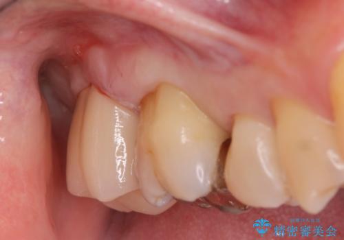 奥歯がしみて痛いの治療後