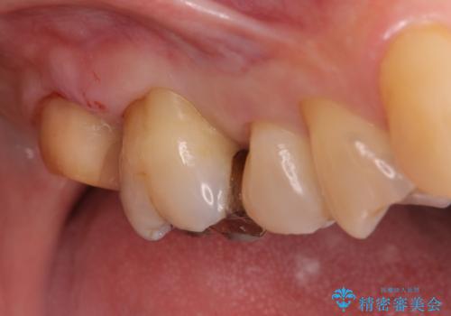 奥歯がしみて痛いの治療中