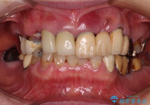前歯をきれいにしたい　インプラントや部分矯正を用いた総合歯科治療の治療前