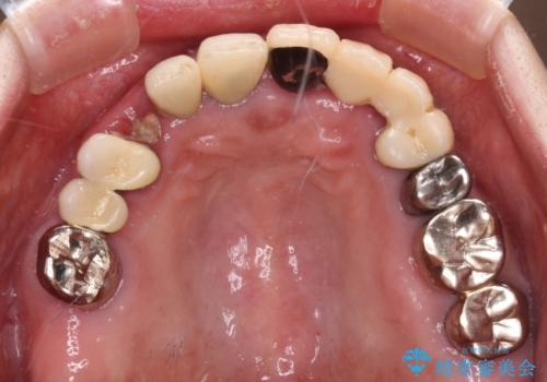 前歯をきれいにしたい インプラントや部分矯正を用いた総合歯科治療の治療前