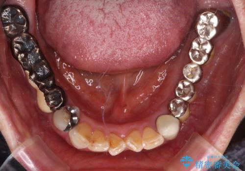 前歯をきれいにしたい インプラントや部分矯正を用いた総合歯科治療の治療前