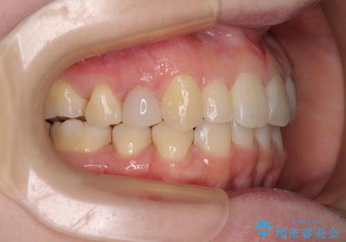 先天欠損のある歯列　インビザライン矯正の治療中
