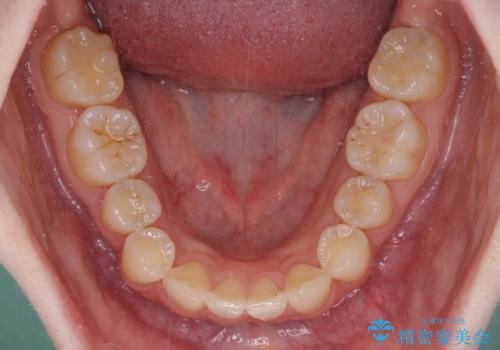 先天欠損のある歯列　インビザライン矯正の治療中