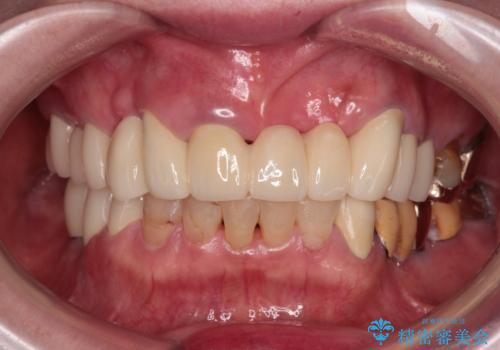 前歯をきれいにしたい　インプラントや部分矯正を用いた総合歯科治療の症例 治療後