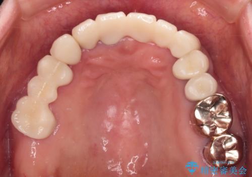 前歯をきれいにしたい インプラントや部分矯正を用いた総合歯科治療の治療後