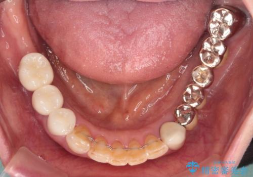 前歯をきれいにしたい インプラントや部分矯正を用いた総合歯科治療の治療後