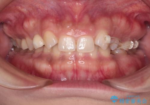 【総合歯科治療】インプラント+インビザラインの治療中