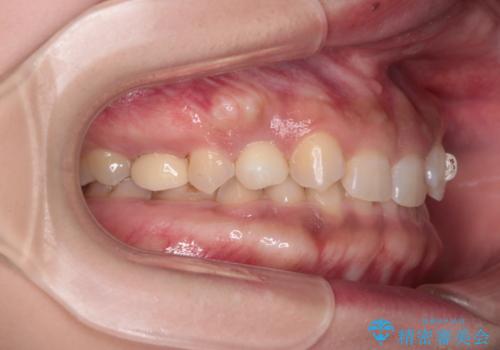 【総合歯科治療】インプラント+インビザラインの治療中