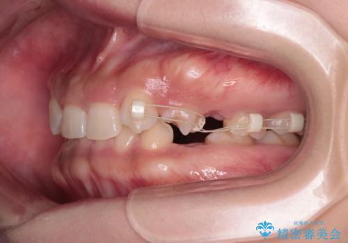 【総合歯科治療】インプラント+インビザラインの治療中