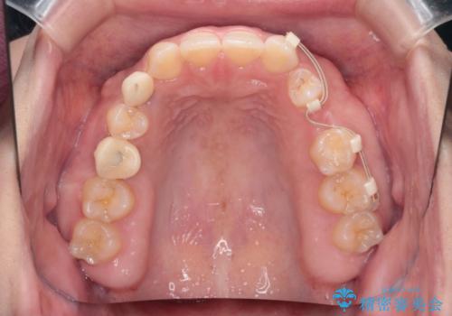 【総合歯科治療】インプラント+インビザラインの治療中