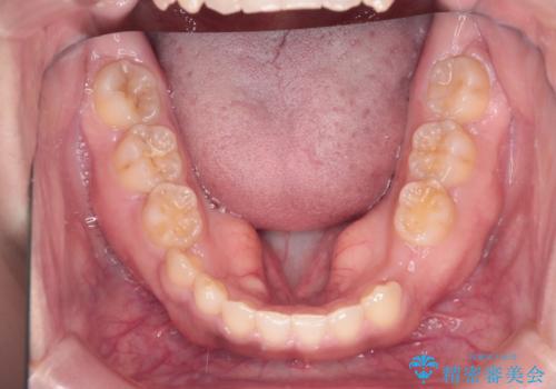 【総合歯科治療】インプラント+インビザラインの治療中