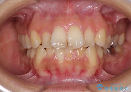 デコボコと口元の突出感　ハーフリンガルでの抜歯矯正の症例 治療前