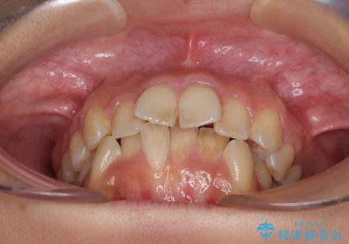 デコボコと口元の突出感 ハーフリンガルでの抜歯矯正の治療前