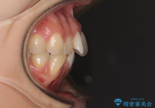 デコボコと口元の突出感 ハーフリンガルでの抜歯矯正の治療前