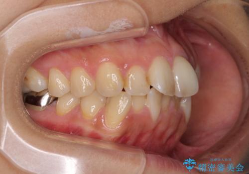 デコボコと口元の突出感 ハーフリンガルでの抜歯矯正の治療前