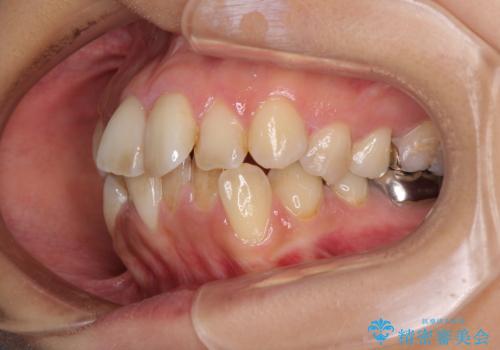 デコボコと口元の突出感　ハーフリンガルでの抜歯矯正の治療前