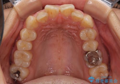 デコボコと口元の突出感 ハーフリンガルでの抜歯矯正の治療前