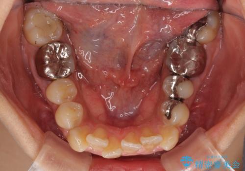 デコボコと口元の突出感　ハーフリンガルでの抜歯矯正の治療前