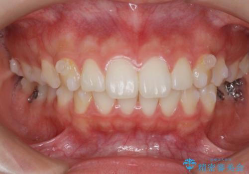 矯正治療を途中でやめてしまった、途中からの治療希望の治療中