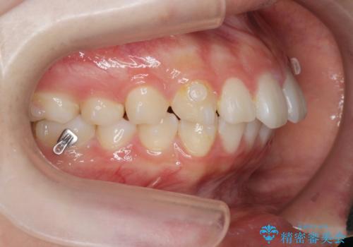 矯正治療を途中でやめてしまった、途中からの治療希望の治療中