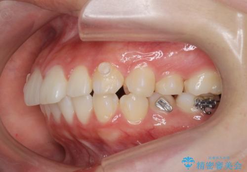 矯正治療を途中でやめてしまった、途中からの治療希望の治療中