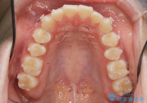 矯正治療を途中でやめてしまった、途中からの治療希望の治療中