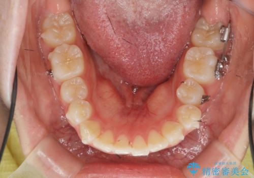 矯正治療を途中でやめてしまった、途中からの治療希望の治療中