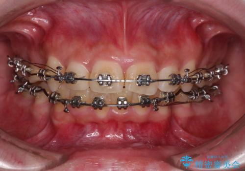 下顎前歯が隠れて突出した口元　ワイヤー装置での抜歯矯正の治療中