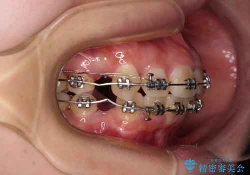 下顎前歯が隠れて突出した口元 ワイヤー装置での抜歯矯正の治療中