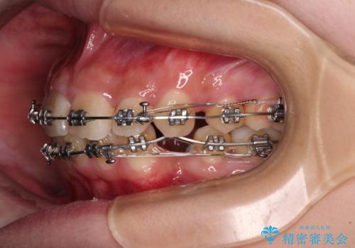 下顎前歯が隠れて突出した口元 ワイヤー装置での抜歯矯正の治療中