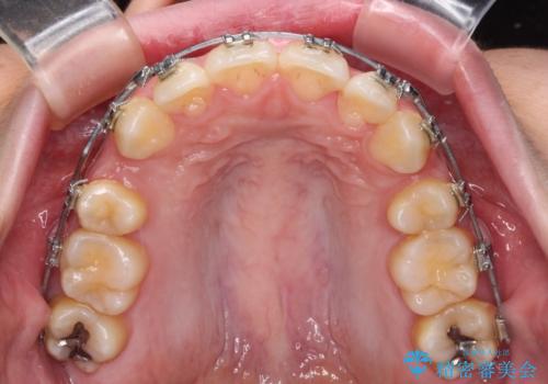 下顎前歯が隠れて突出した口元 ワイヤー装置での抜歯矯正の治療中
