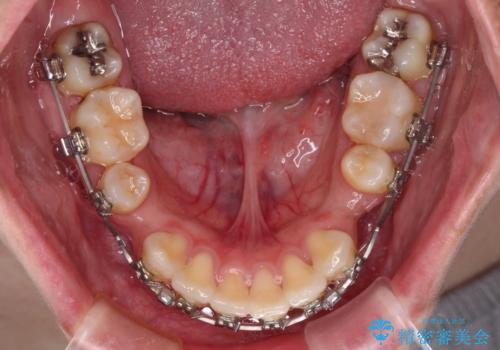 下顎前歯が隠れて突出した口元 ワイヤー装置での抜歯矯正の治療中
