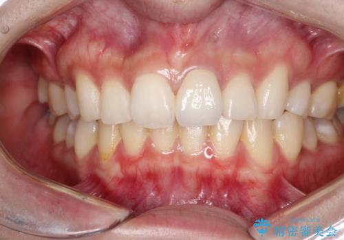 前歯が欠けるの治療後