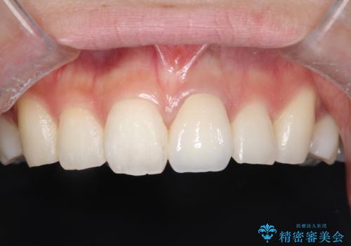 前歯が欠けるの症例 治療後