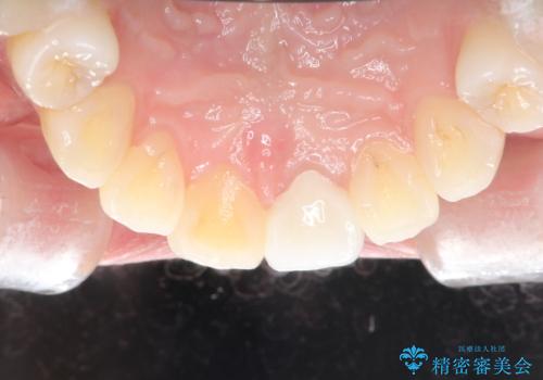 前歯が欠けるの治療後