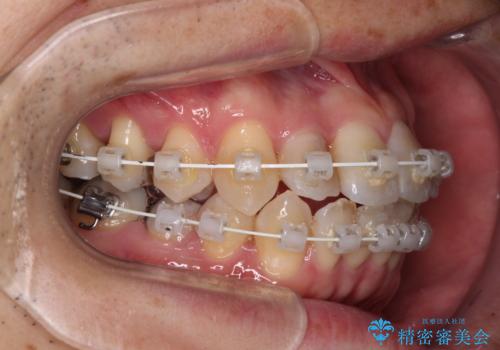 前歯のクロスバイト　目立たないワイヤー装置で矯正治療の治療中